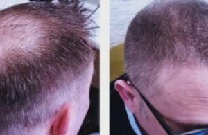 Putting an end to baldness